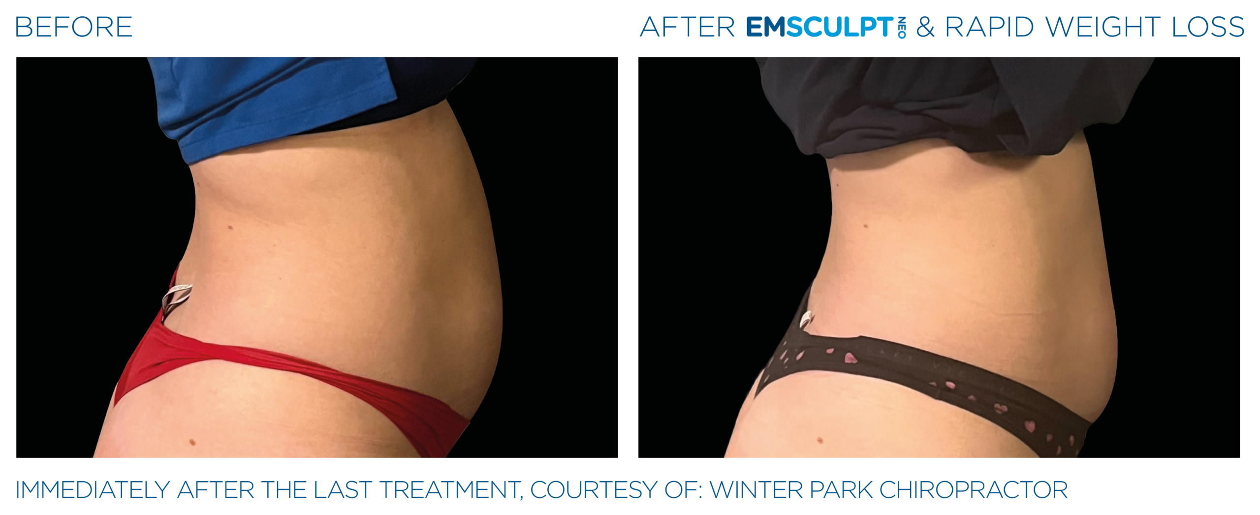 Emsculpt_Neo_Weight_Loss_PIC_Ba_card_female_abdomen_012_ENUS101