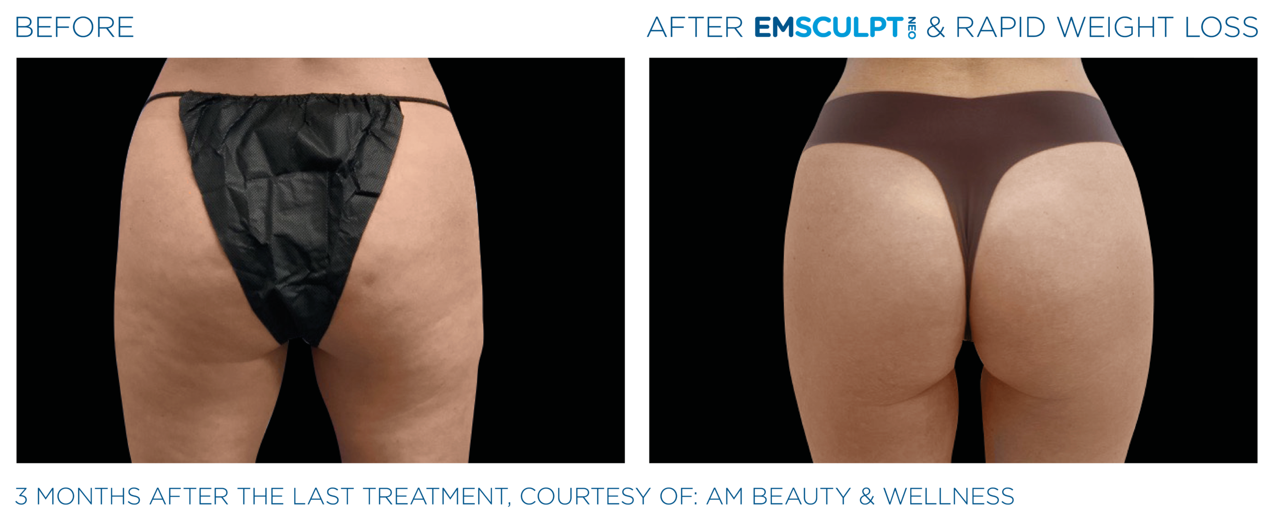 Emsculpt_Neo_Weight_Loss_PIC_Ba_card_female_buttocks_005_ENUS100