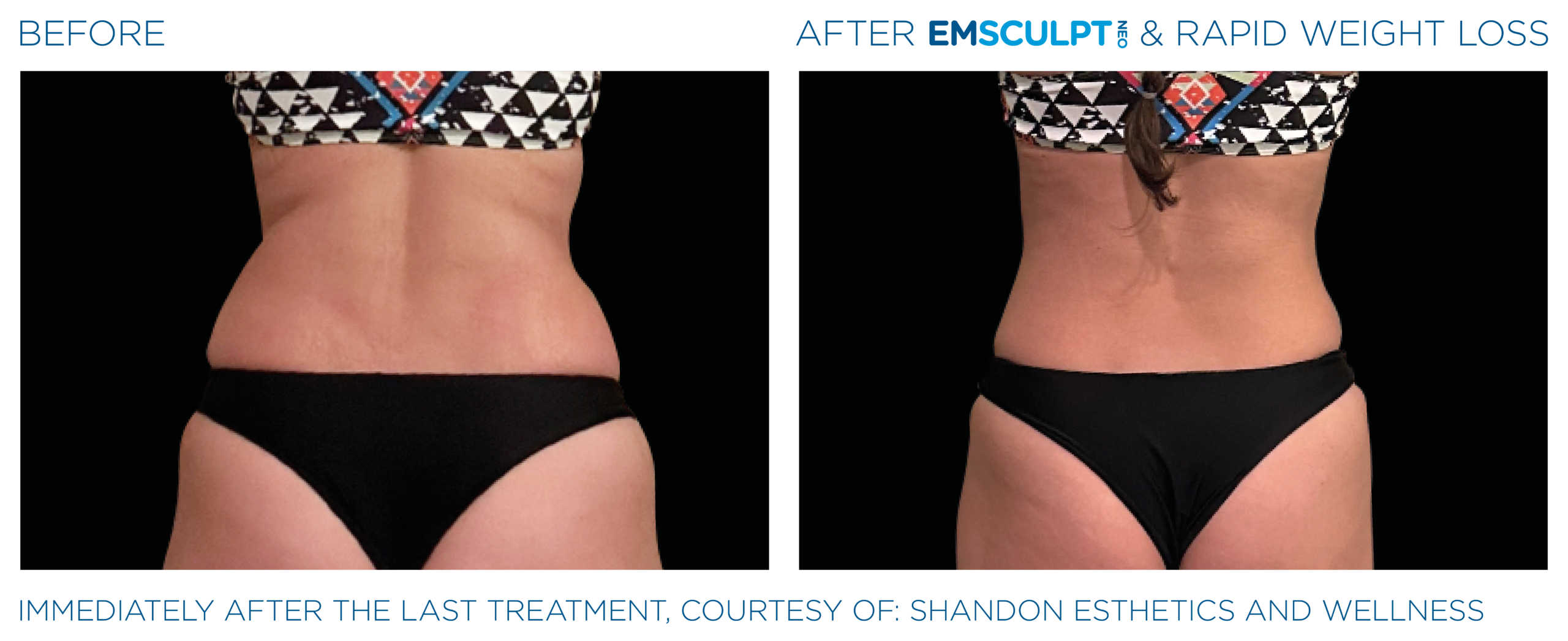 Emsculpt_Neo_Weight_Loss_PIC_Ba_card_female_lateral_abdomen_008_ENUS100