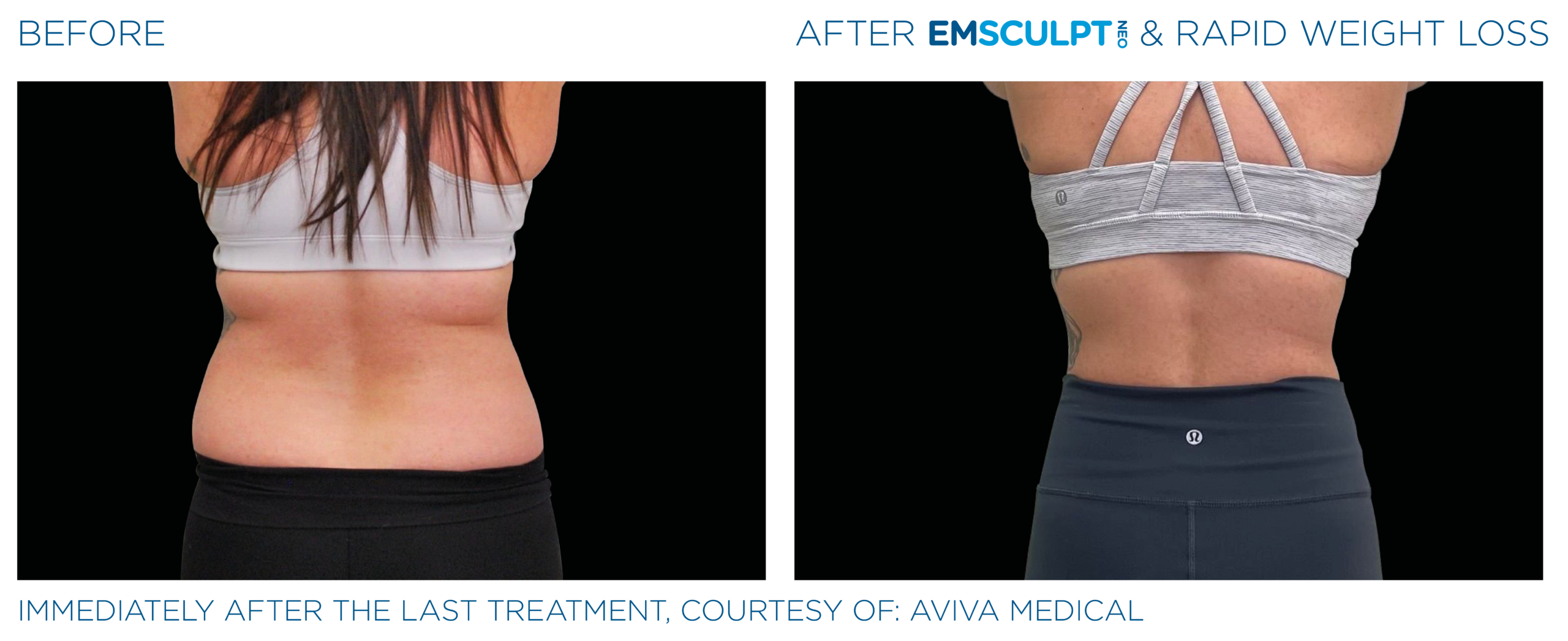 Emsculpt_Neo_Weight_Loss_PIC_Ba_card_female_lateral_abdomen_014_ENUS100