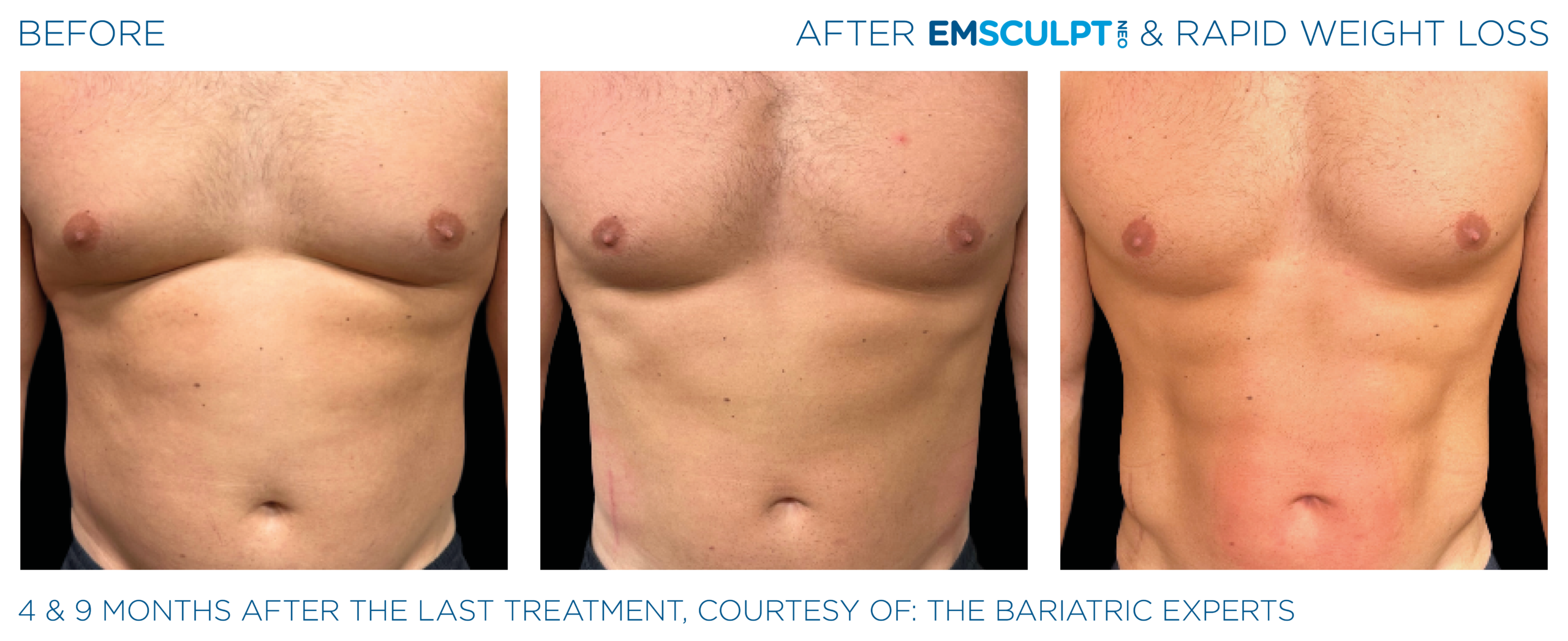 Emsculpt_Neo_Weight_Loss_PIC_Ba_card_male_abdomen_009_ENUS100