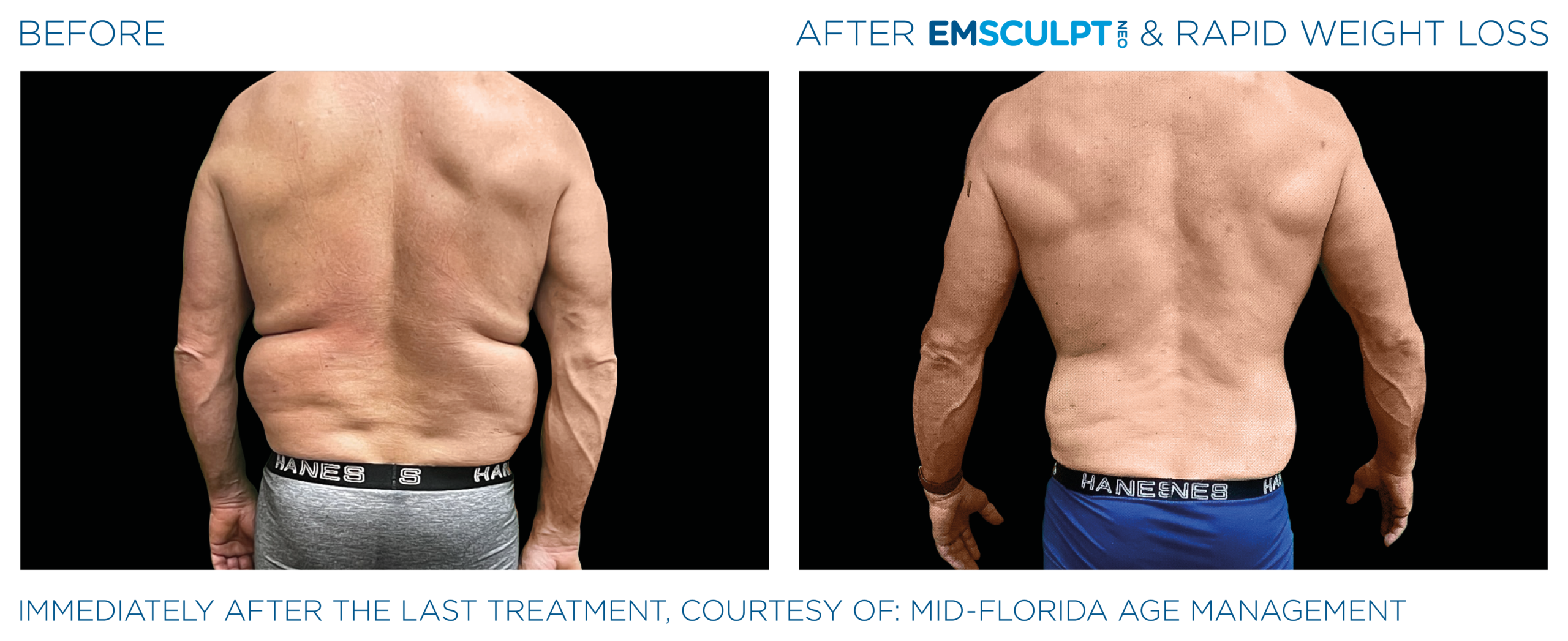 Emsculpt_Neo_Weight_Loss_PIC_Ba_card_male_lateral_abdomen_011_ENUS100